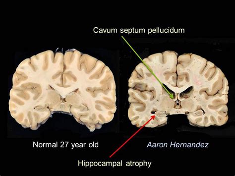 aaron hernandez brain